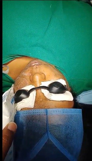 Pico Laser Treatment